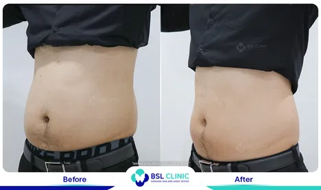 รีวิวลดไขมัน