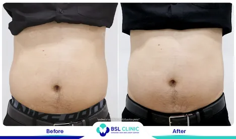 รีวิวลดไขมัน