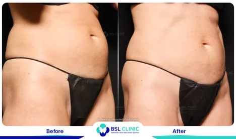 รีวิวลดไขมัน