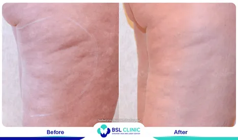 รีวิวลดไขมัน