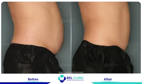 รีวิวกระชับสัดส่วน