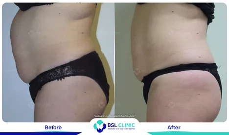 รีวิวกระชับสัดส่วน