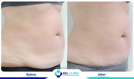 รีวิวกระชับสัดส่วน