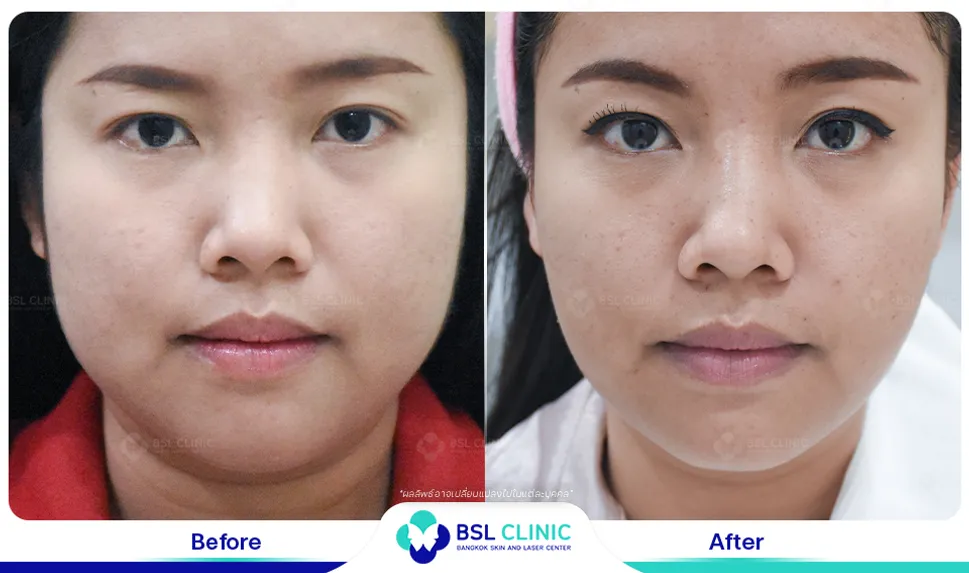 รีวิวยกกระชับปรับรูปหน้า