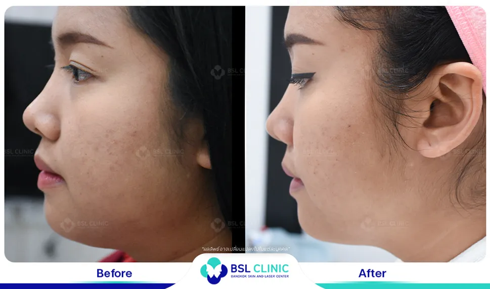 รีวิวยกกระชับปรับรูปหน้า