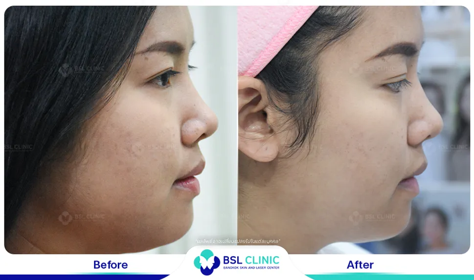 รีวิวยกกระชับปรับรูปหน้า