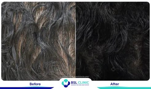 รีวิวรักษาปลูกผม