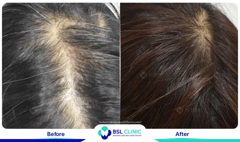 รีวิวรักษาปลูกผม