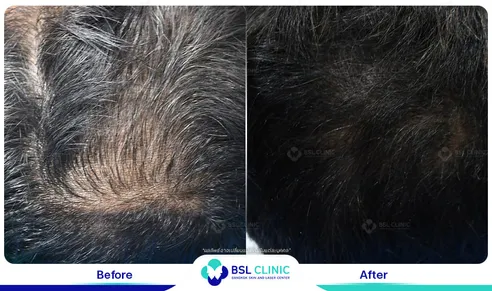 รีวิวรักษาปลูกผม