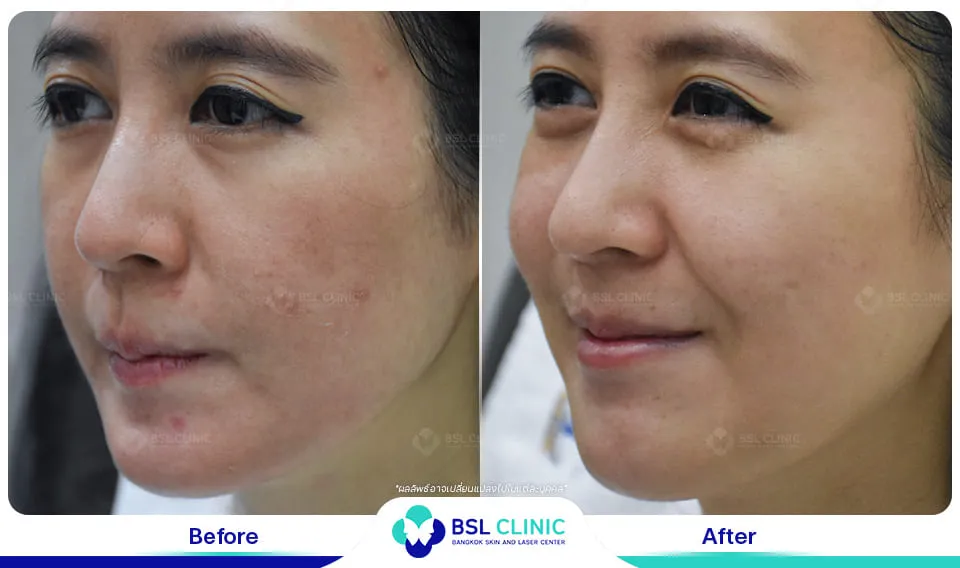 รีวิวผิวแพ้ง่าย