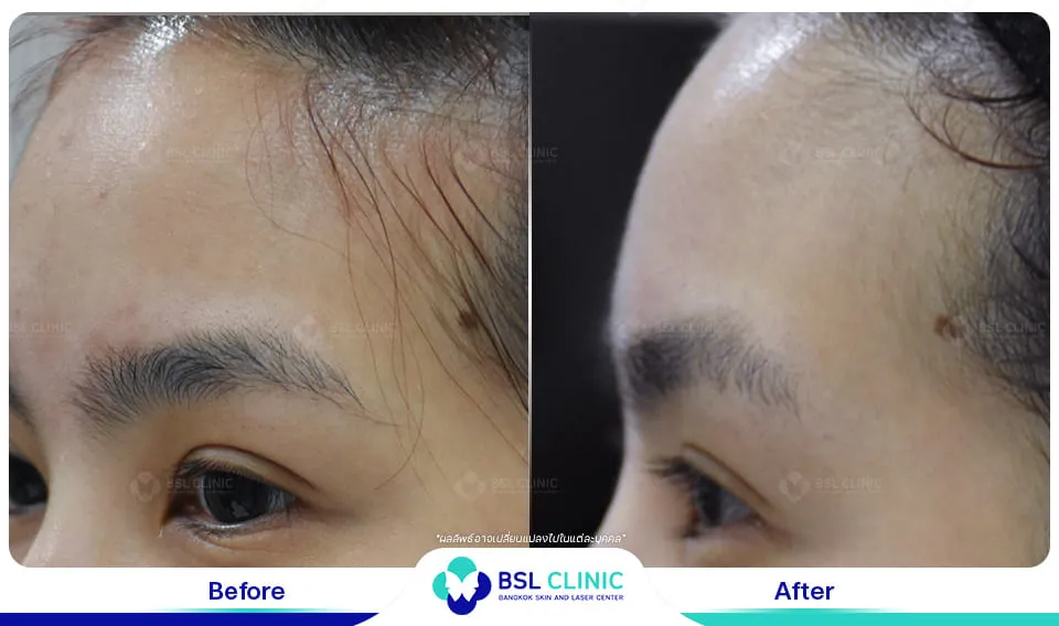 ผิวแพ้ง่าย