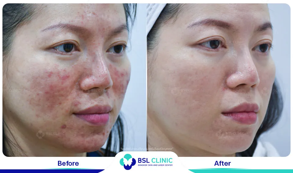 รีวิวรักษาผิวแพ้ง่าย