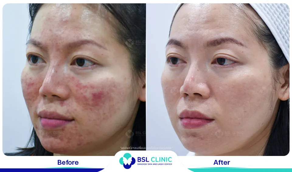 รีวิวรักษาผิวแพ้ง่าย