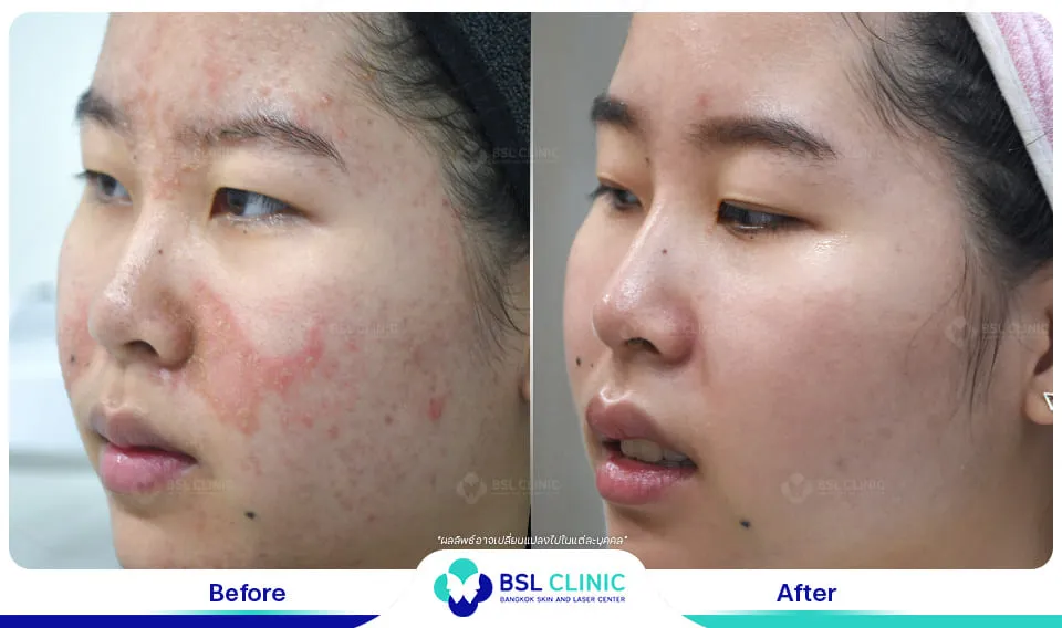 รีวิวรักษาผิวแพ้ง่าย