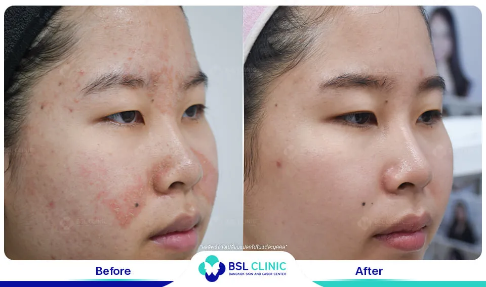 รีวิวรักษาผิวแพ้ง่าย