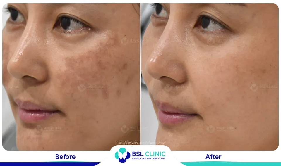 รีวิวรักษาฝ้า