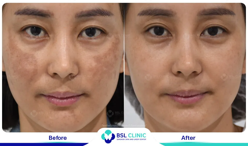 รีวิวรักษาฝ้า