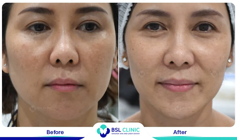 รีวิวรักษาฝ้า