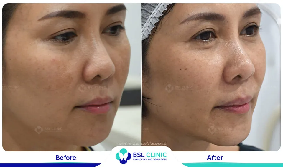 รีวิวรักษาฝ้า