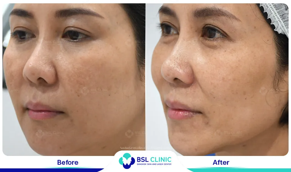 รีวิวรักษาฝ้า