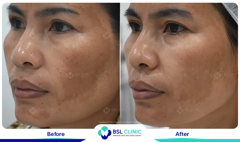 รีวิวรักษาฝ้า