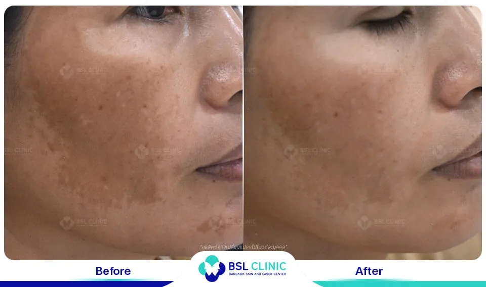 รีวิวรักษาฝ้า