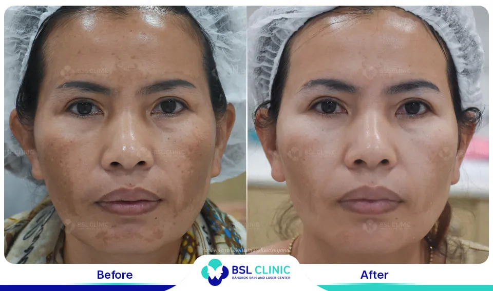 รีวิวรักษาฝ้า