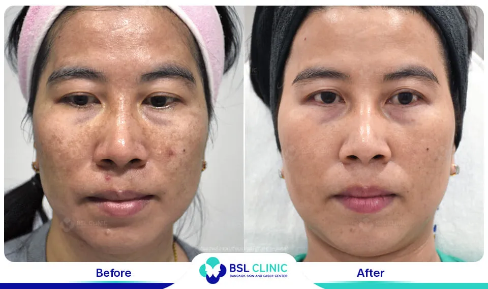 รีวิวรักษาฝ้า