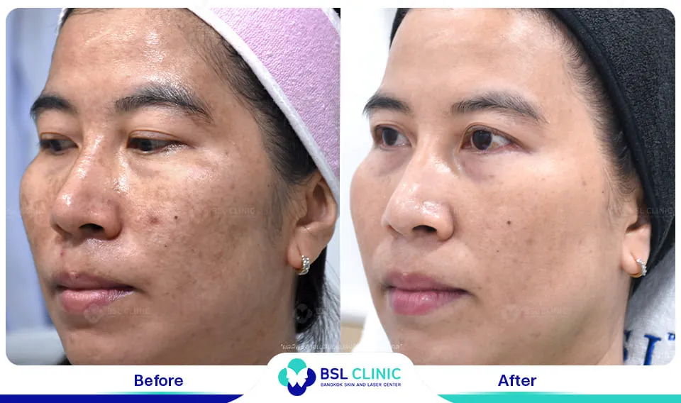 รีวิวรักษาฝ้า