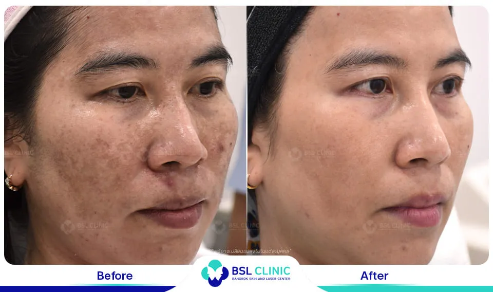 รีวิวรักษาฝ้า