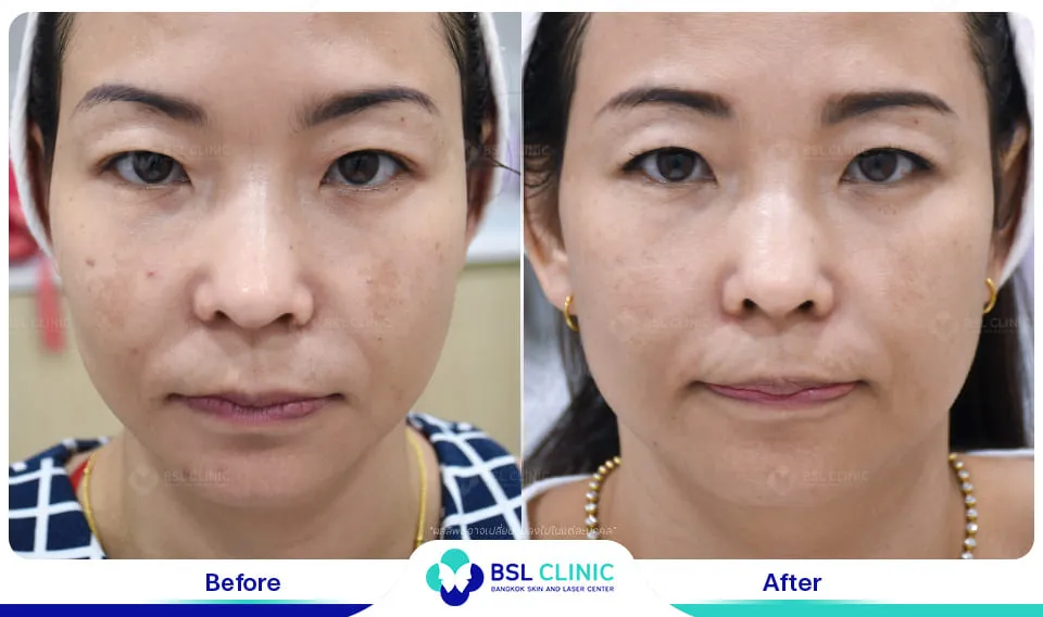 เลเซอร์ฝ้า