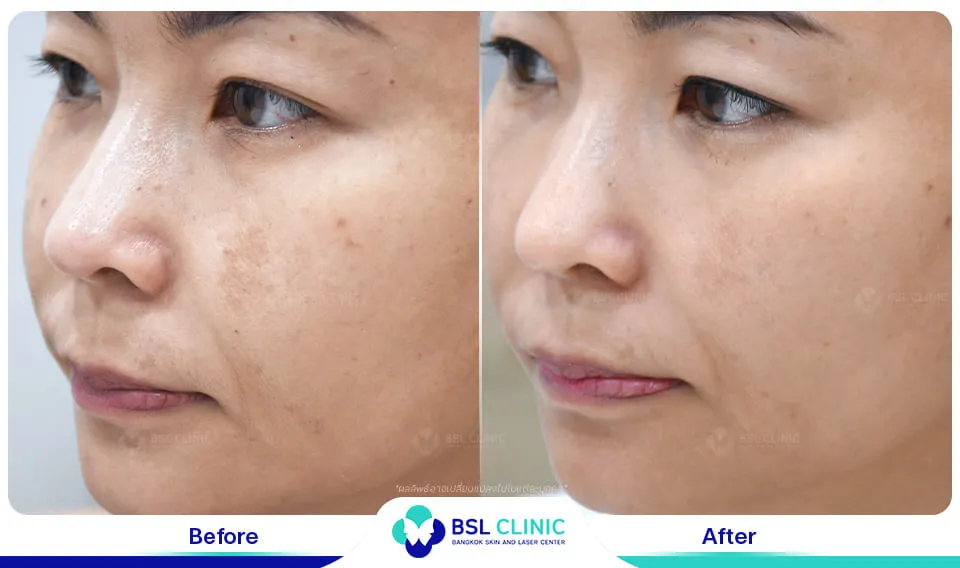 เลเซอร์ฝ้า