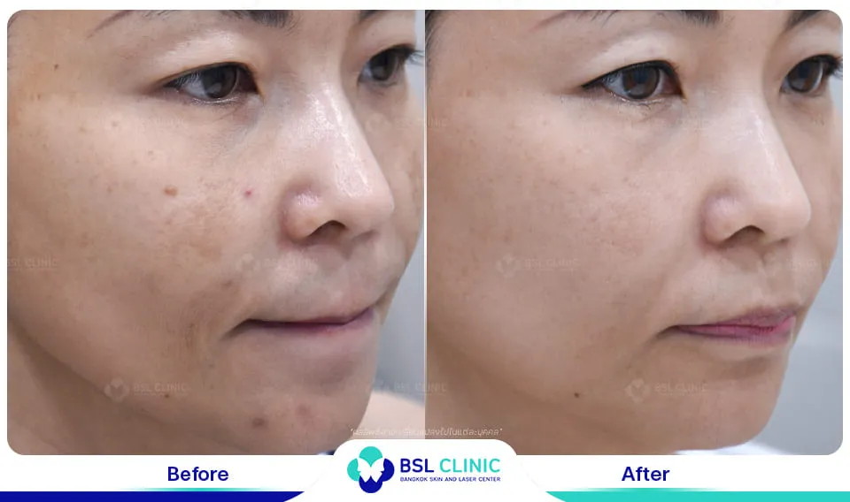 เลเซอร์ฝ้า