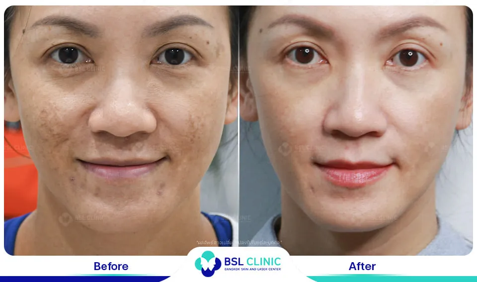 เลเซอร์ฝ้า