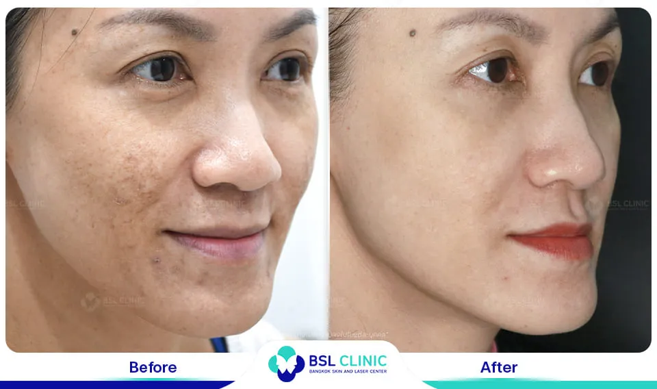 เลเซอร์ฝ้า