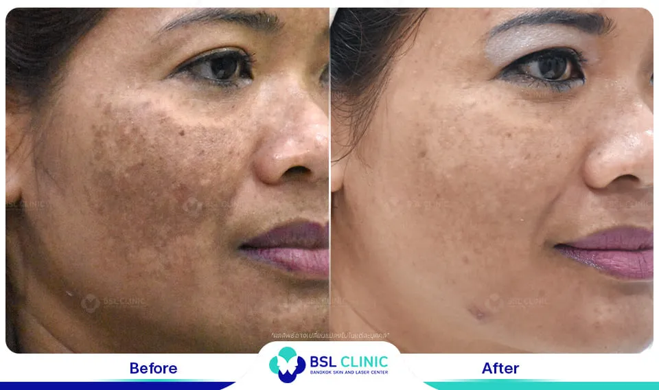 เลเซอร์ฝ้า