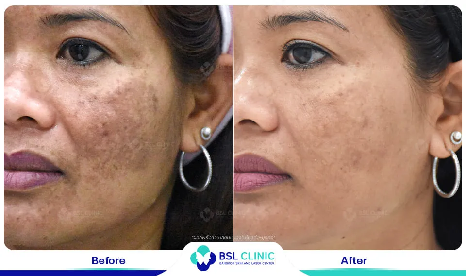 เลเซอร์ฝ้า