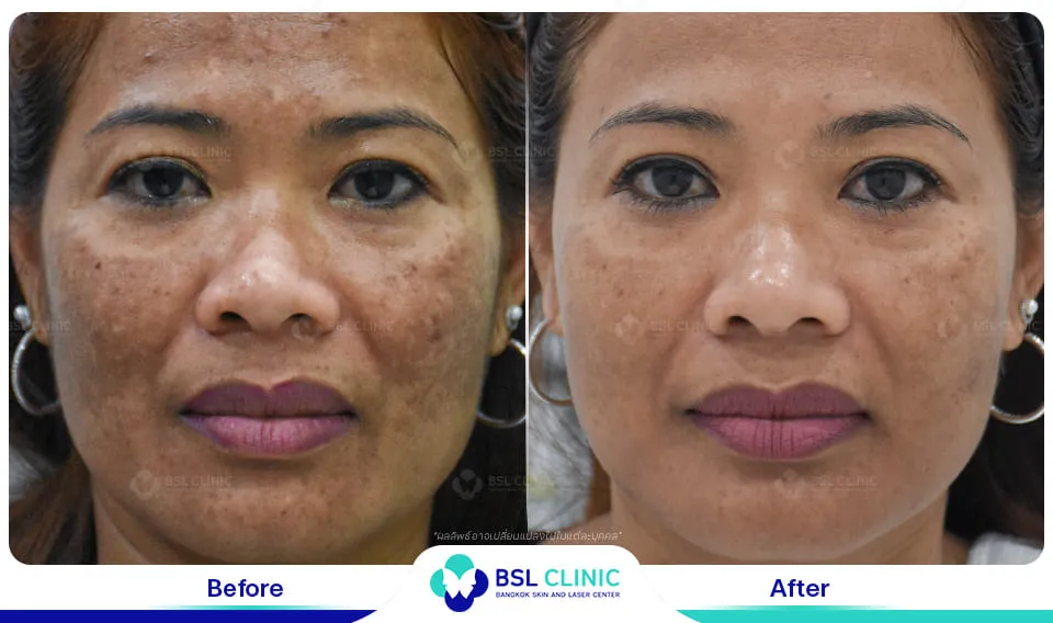 เลเซอร์ฝ้า