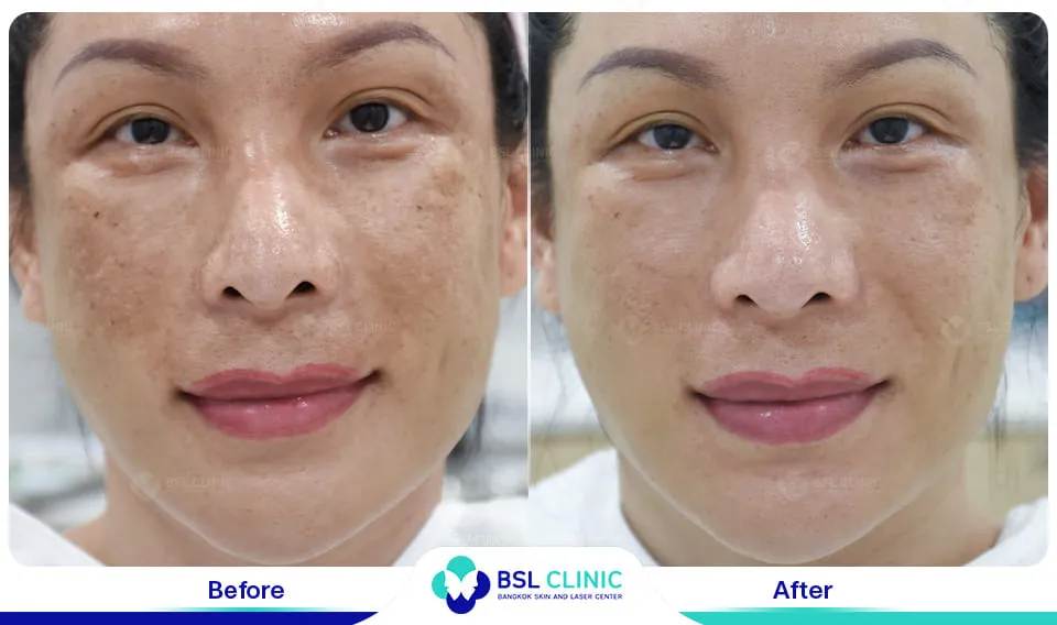 เลเซอร์ฝ้า