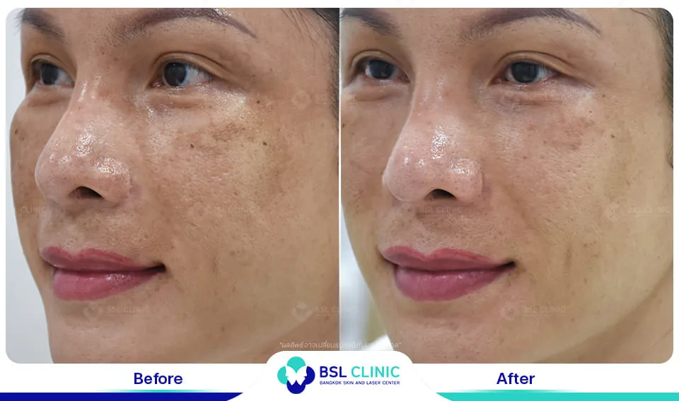 เลเซอร์ฝ้า