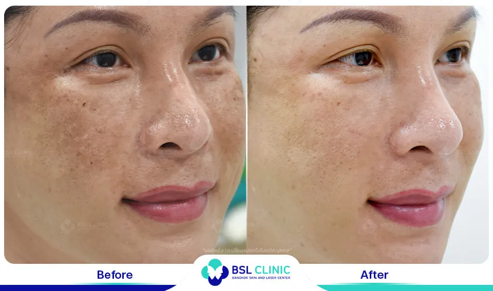 เลเซอร์ฝ้า