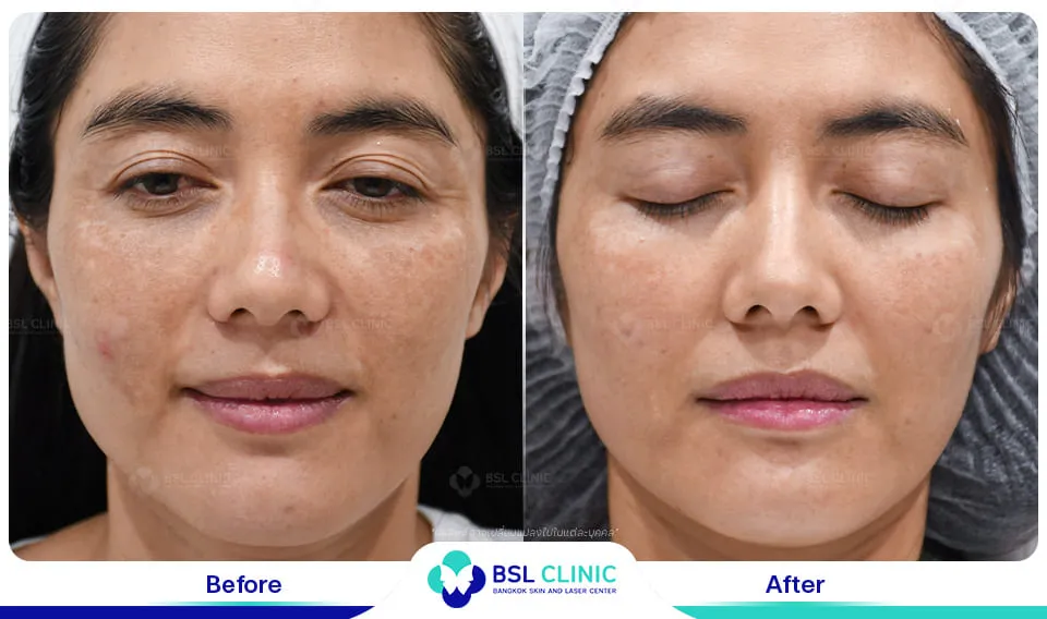 รักษาฝ้ากระ