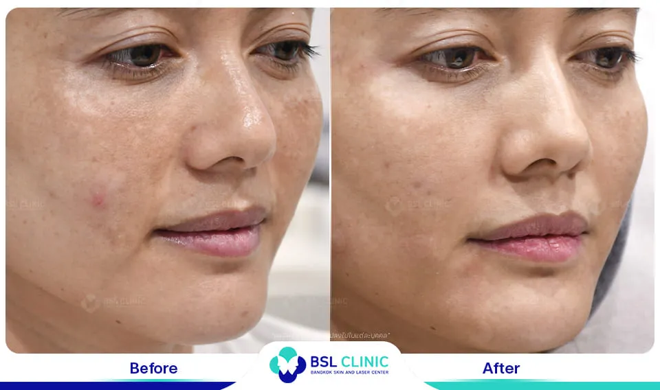 รักษาฝ้ากระ