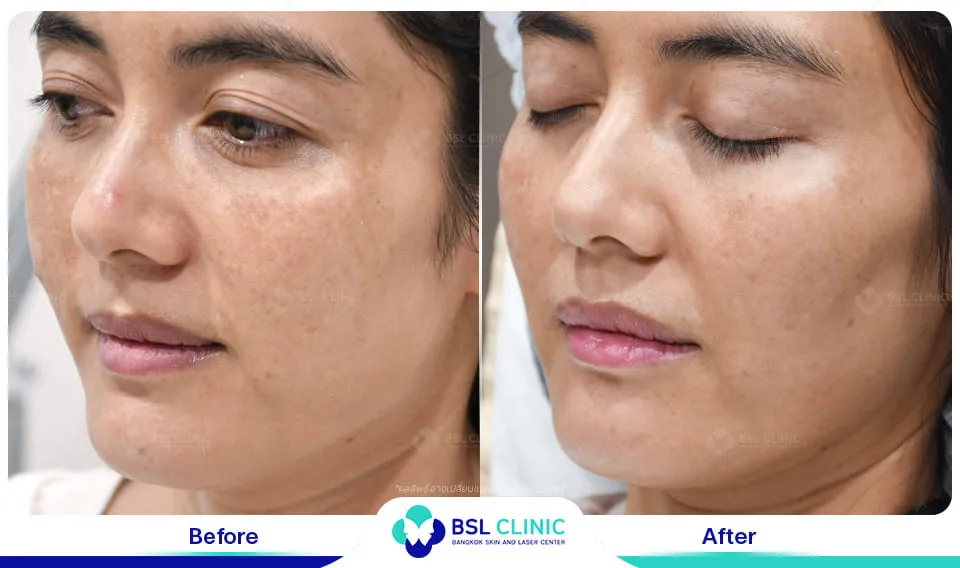 รักษาฝ้ากระ