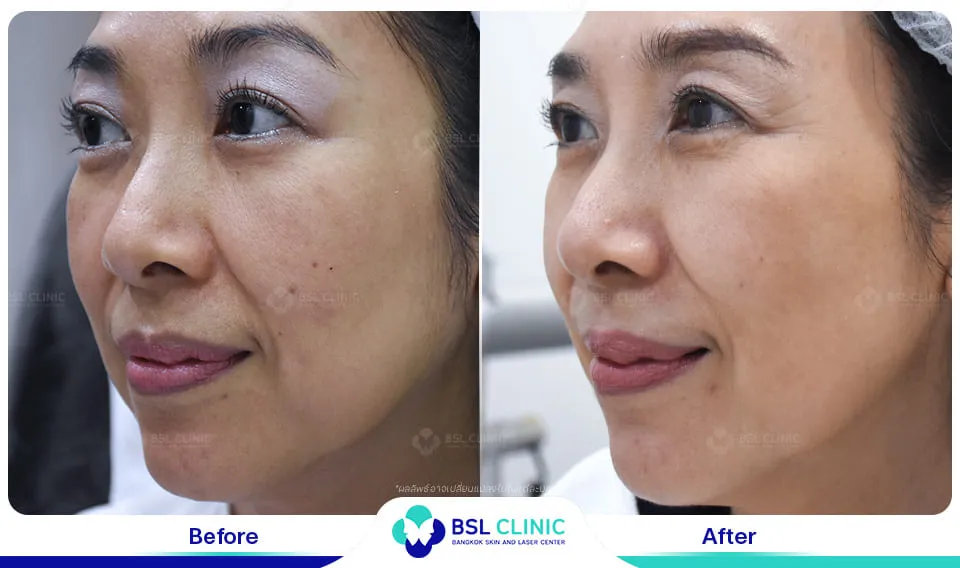 รักษาฝ้ากระ