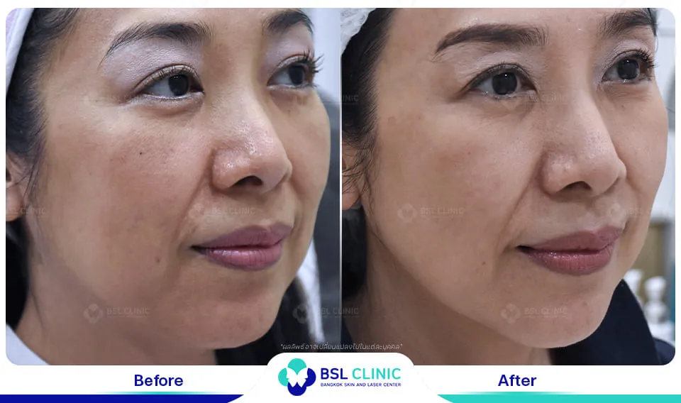 รักษาฝ้ากระ