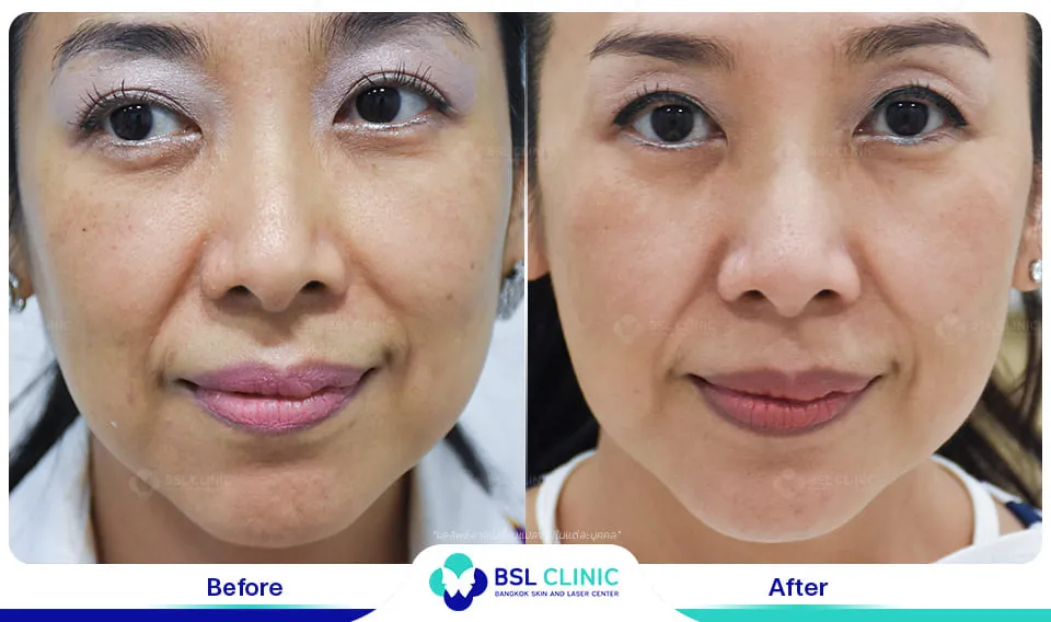 รักษาฝ้ากระ