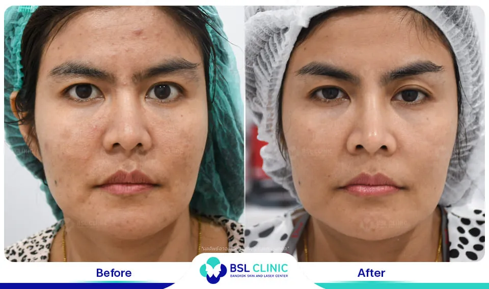 รักษาฝ้ากระ