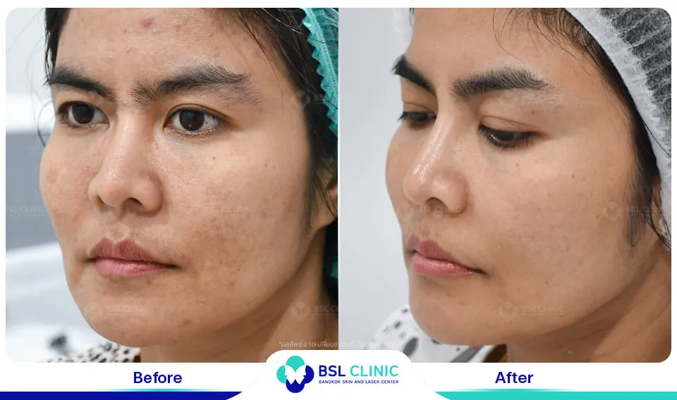 รักษาฝ้ากระ