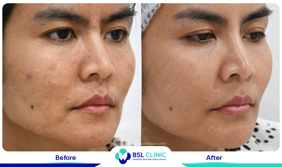 รักษาฝ้ากระ